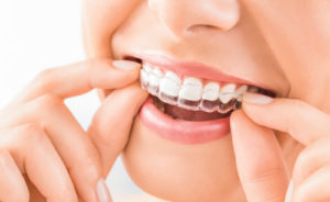 Invisalign Mansfield, Invisible Braces Mansfield